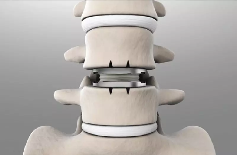 Mổ thay đĩa đệm nhân tạo là phương pháp cuối cùng được lựa chọn để cải thiện tình trạng đau nhức lưng